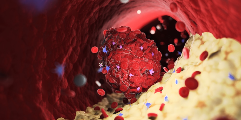 3D-Illustration eines Blutgerinnsels (Thrombus) in einer Arterie, umgeben von roten Blutkörperchen und Plaqueablagerungen, das den Blutfluss blockiert.